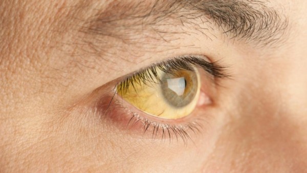 Ojos amarillos, uno de los síntomas de la hepatitis A. Foto: Internet