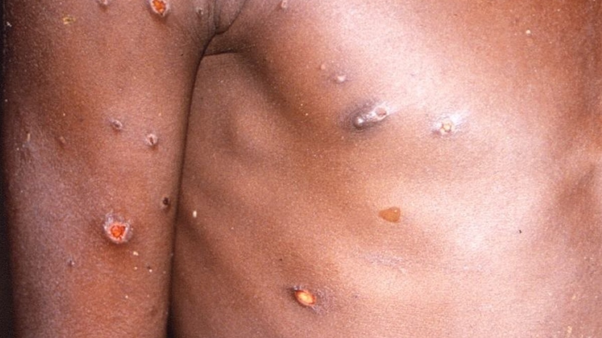La viruela del mono produce lesiones cutáneas, fiebre y dolor corporal en las personas afectadas por el virus.